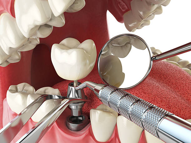 Best Lost Filling or Crown Replacement in Folcroft, PA